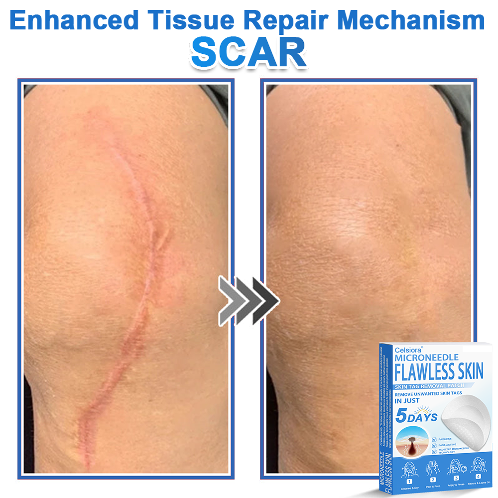 ✅ 2-in-1 Microneedle & Hydrocolloid Patch | Raised Moles,Acne, Flat Warts & Skin Tags Remover | Improves Wrinkles, Scars & Blemishes | Invisible Pimple Patches for Face & Body