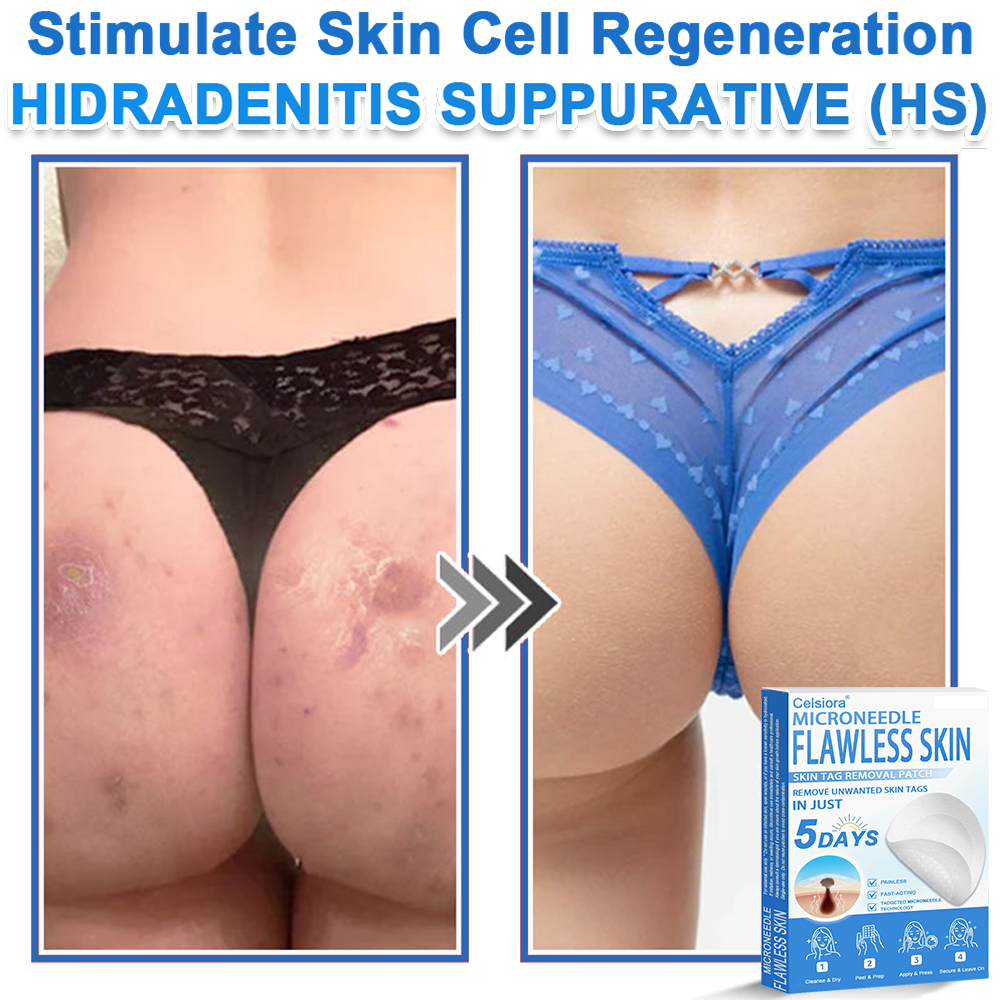 ✅ 2-in-1 Microneedle & Hydrocolloid Patch | Raised Moles,Acne,  Flat Warts & Skin Tags Remover | Improves Wrinkles, Scars & Blemishes | Invisible Pimple Patches for Face & Body