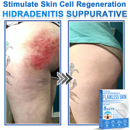 ✅ 2-in-1 Microneedle & Hydrocolloid Patch | Raised Moles,Acne,  Flat Warts & Skin Tags Remover | Improves Wrinkles, Scars & Blemishes | Invisible Pimple Patches for Face & Body