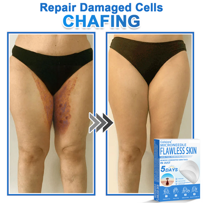 ✅ 2-in-1 Microneedle & Hydrocolloid Patch | Raised Moles,Acne,  Flat Warts & Skin Tags Remover | Improves Wrinkles, Scars & Blemishes | Invisible Pimple Patches for Face & Body