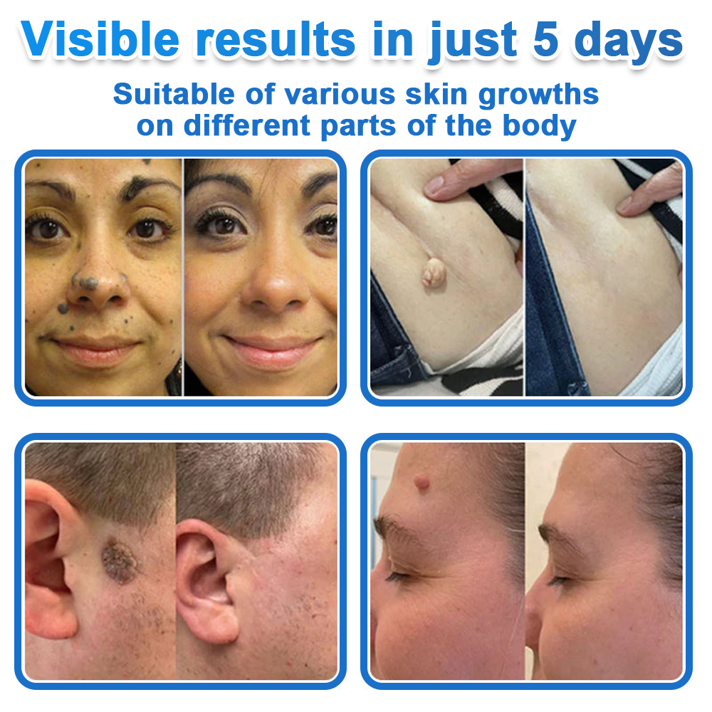 ✅ 2-in-1 Microneedle & Hydrocolloid Patch | Raised Moles,Acne,  Flat Warts & Skin Tags Remover | Improves Wrinkles, Scars & Blemishes | Invisible Pimple Patches for Face & Body
