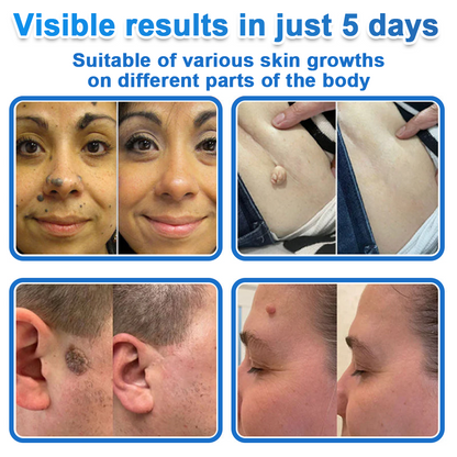 ✅ 2-in-1 Microneedle & Hydrocolloid Patch | Raised Moles,Acne,  Flat Warts & Skin Tags Remover | Improves Wrinkles, Scars & Blemishes | Invisible Pimple Patches for Face & Body