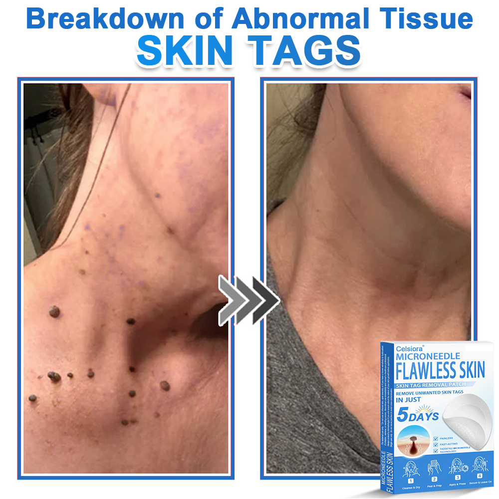 ✅ 2-in-1 Microneedle & Hydrocolloid Patch | Raised Moles,Acne,  Flat Warts & Skin Tags Remover | Improves Wrinkles, Scars & Blemishes | Invisible Pimple Patches for Face & Body