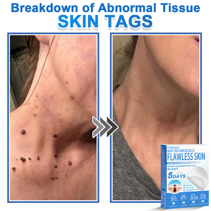 ✅ 2-in-1 Microneedle & Hydrocolloid Patch | Raised Moles,Acne,  Flat Warts & Skin Tags Remover | Improves Wrinkles, Scars & Blemishes | Invisible Pimple Patches for Face & Body