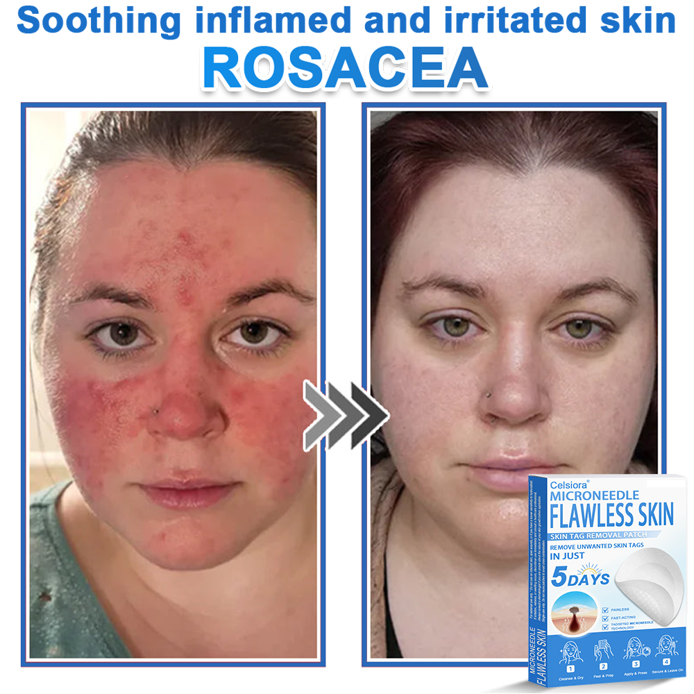 ✅ 2-in-1 Microneedle & Hydrocolloid Patch | Raised Moles,Acne,  Flat Warts & Skin Tags Remover | Improves Wrinkles, Scars & Blemishes | Invisible Pimple Patches for Face & Body