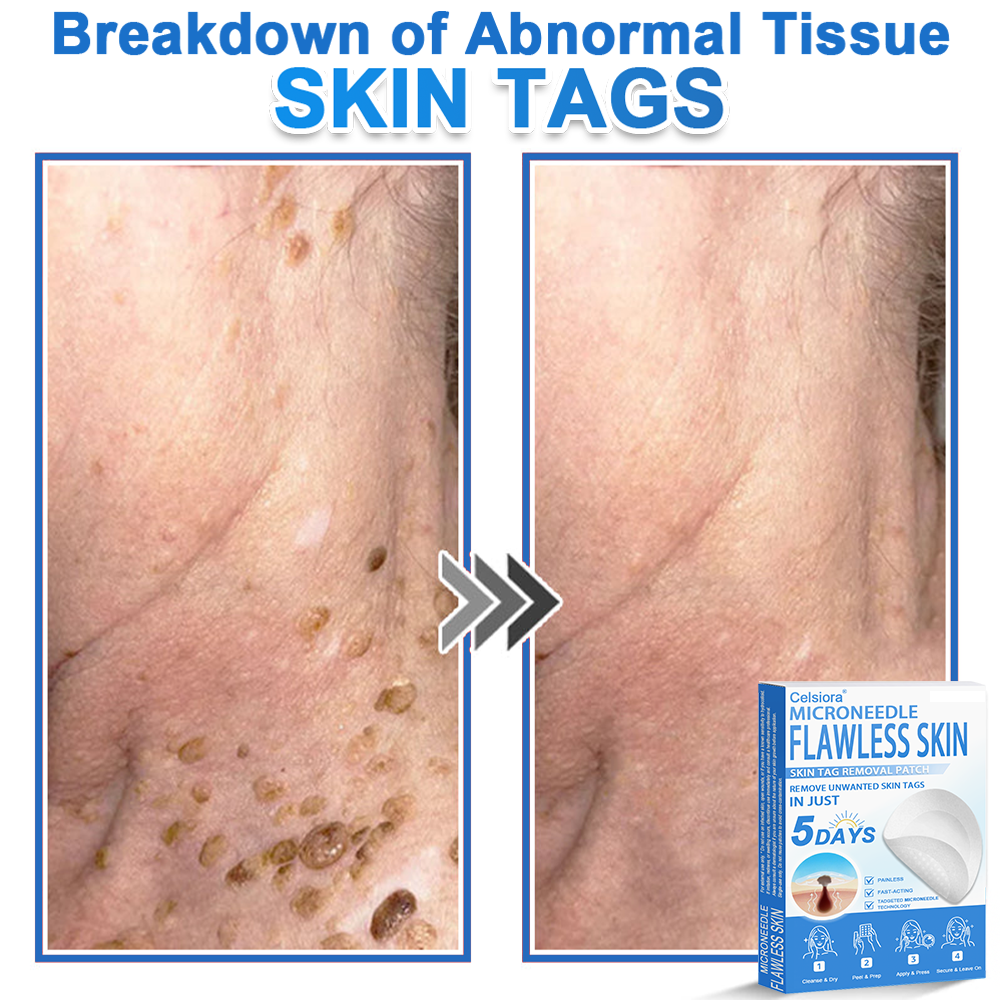 ✅ 2-in-1 Microneedle & Hydrocolloid Patch | Raised Moles,Acne,  Flat Warts & Skin Tags Remover | Improves Wrinkles, Scars & Blemishes | Invisible Pimple Patches for Face & Body