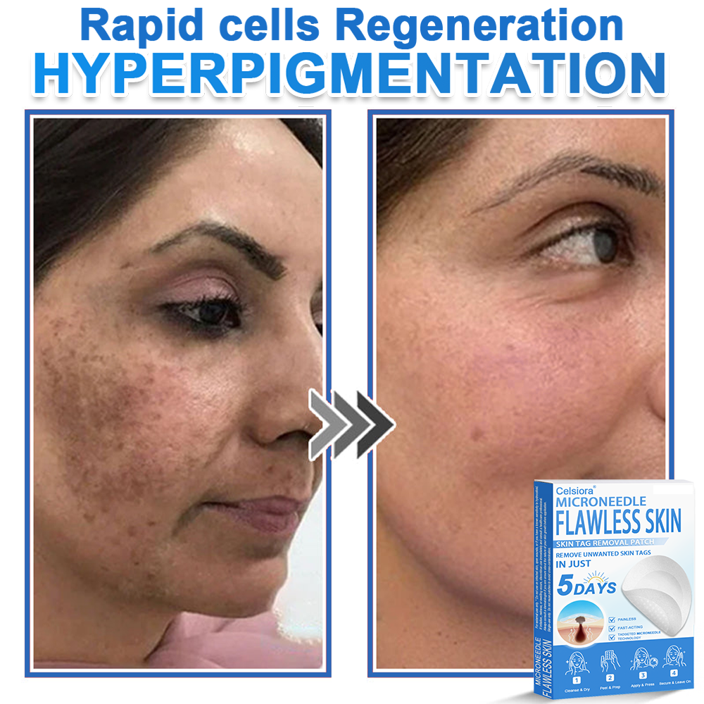 ✅ 2-in-1 Microneedle & Hydrocolloid Patch | Raised Moles,Acne,  Flat Warts & Skin Tags Remover | Improves Wrinkles, Scars & Blemishes | Invisible Pimple Patches for Face & Body