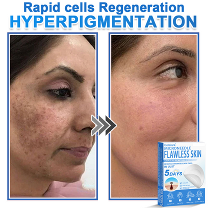 ✅ 2-in-1 Microneedle & Hydrocolloid Patch | Raised Moles,Acne,  Flat Warts & Skin Tags Remover | Improves Wrinkles, Scars & Blemishes | Invisible Pimple Patches for Face & Body