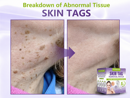 KLENIMORE® Soluble Microneedle Botanical Skin Tag Removal Patch
