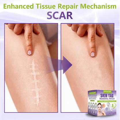 KLENIMORE® Soluble Microneedle Botanical Skin Tag Removal Patch